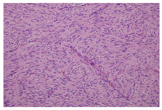 tumor