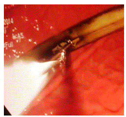 endotracheal