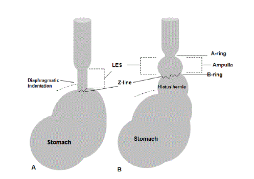 esophageal