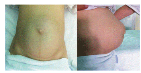 Abdominal
