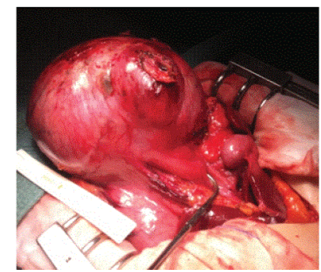 Resection