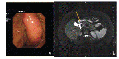 Endoscopic
