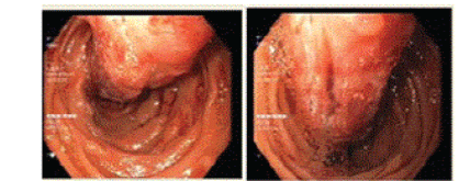 Endoscopic