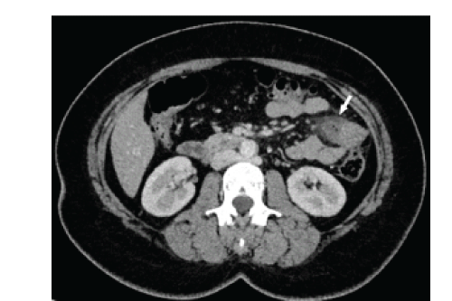Abdominal