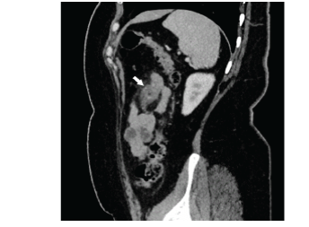 coronal