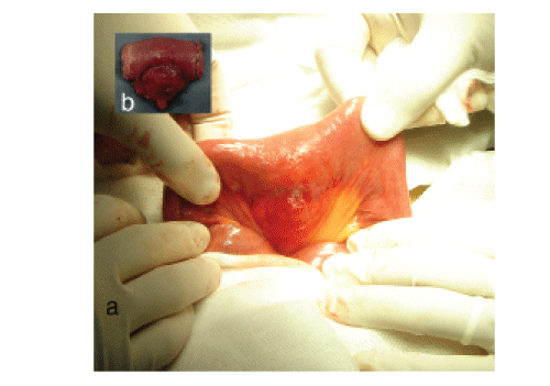 Intraoperative