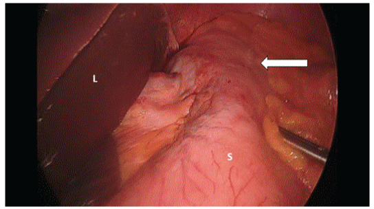 Laparoscopic