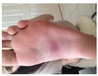Plantar