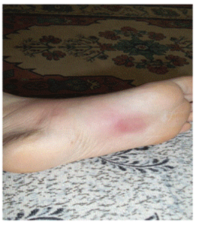 Plantar erythema