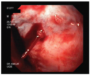 endoscopy