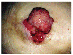 ileostomy