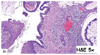 adenocarcinoma