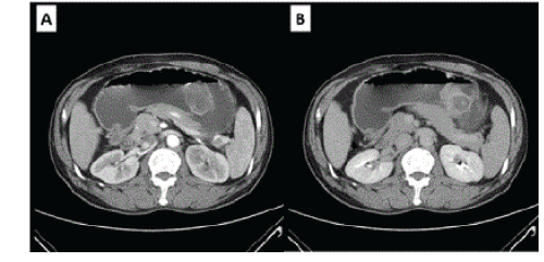 Abdominal
