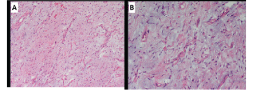 Tumor