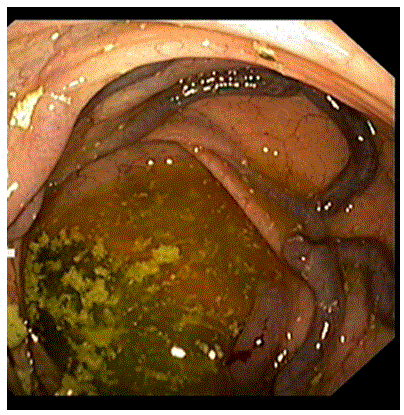 varicosis