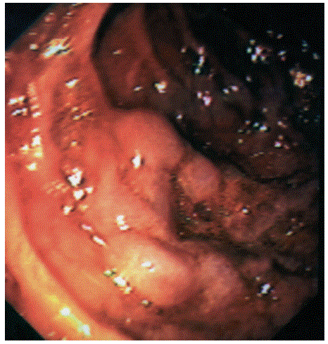 Colonic