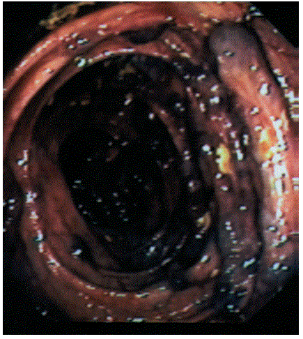 varices