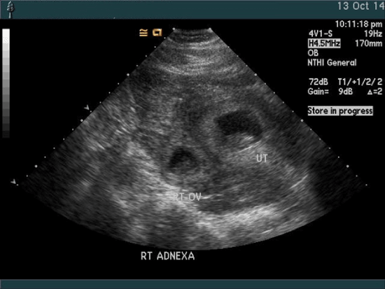 transvaginal