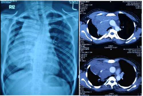Chest X-ray and CT