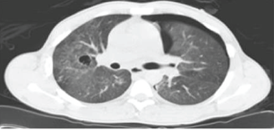 pneumonia