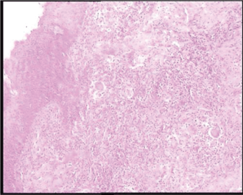biopsy