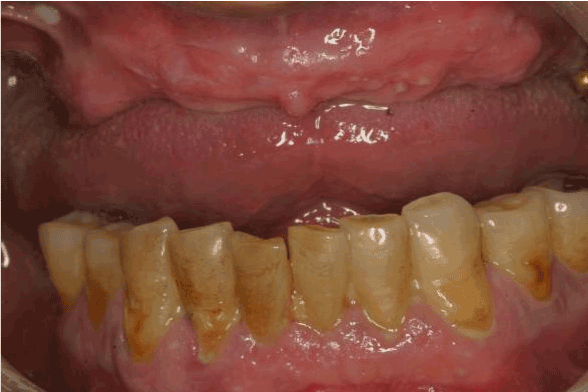 What Is Moderate Generalized Cerebral Atrophy
