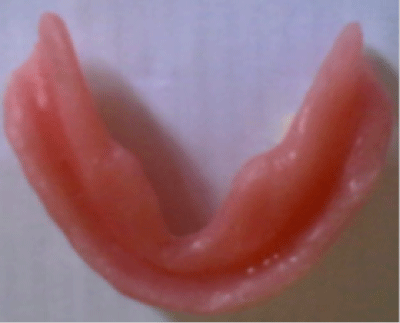 denture