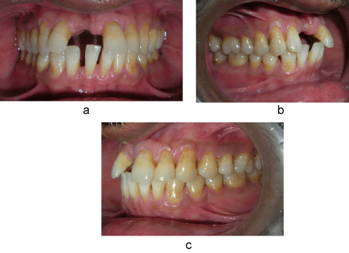 intraoral