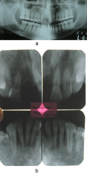 X-ray