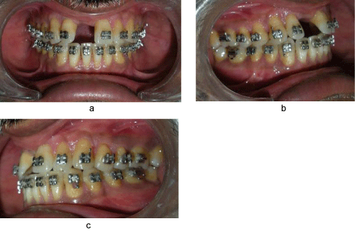 Intraoral