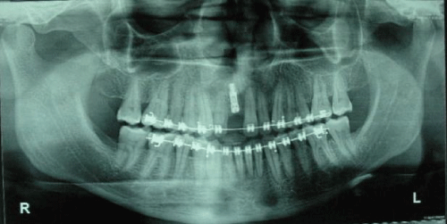  implant