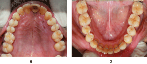 occlusal