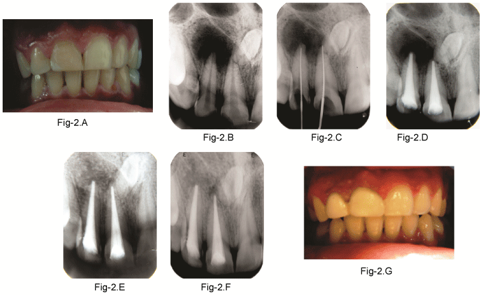 tooth