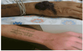 papules