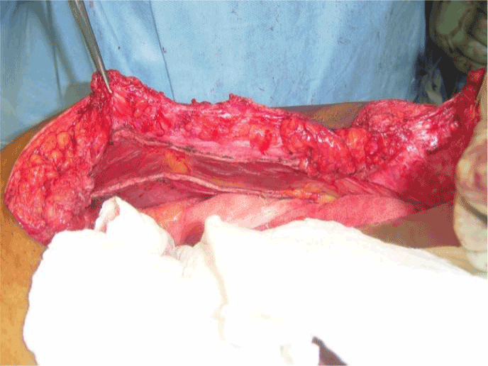 sheath