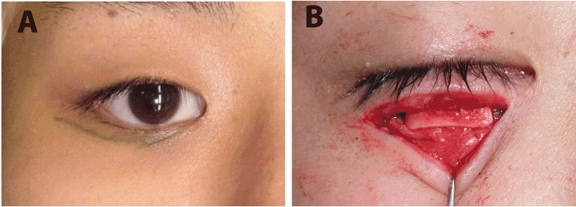 incision