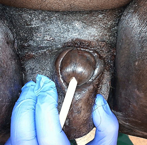 inguinal