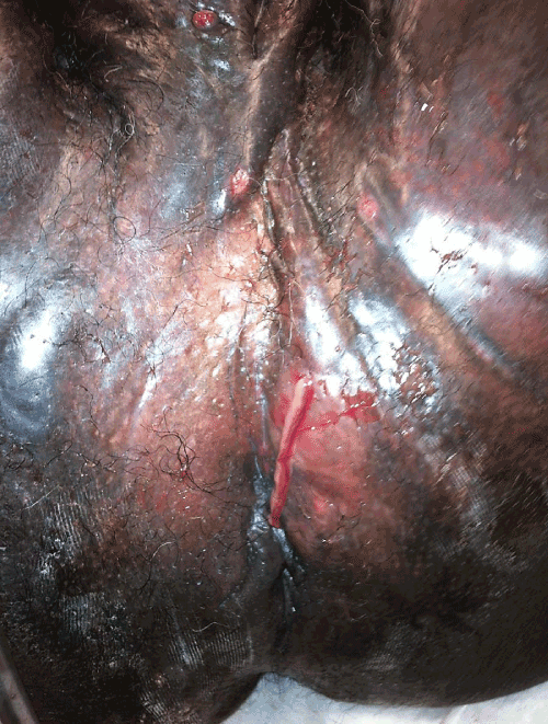 Perineal