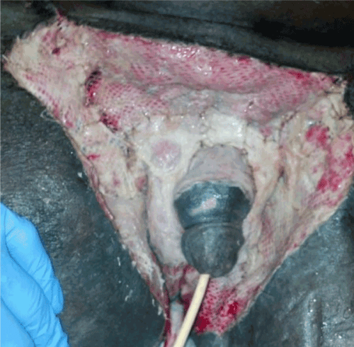 cadaver