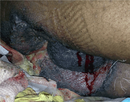hidradenitis