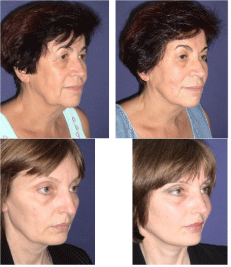 fascial