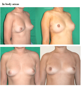 breast
