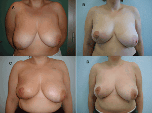 carcinoma