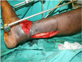 medial