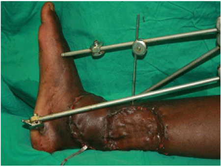 perforator