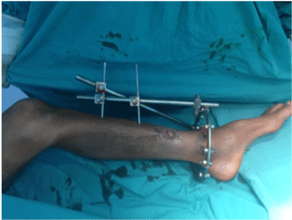 fibula