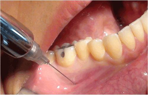 distal