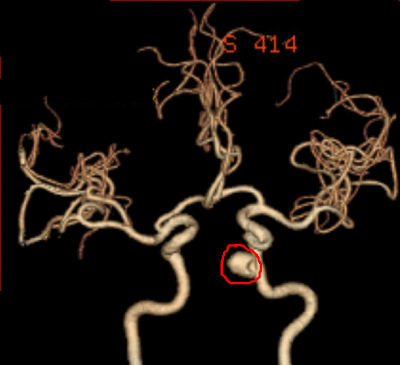 Internal Carotid