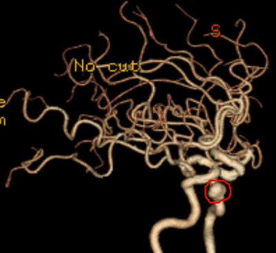 Left Internal Carotid artery