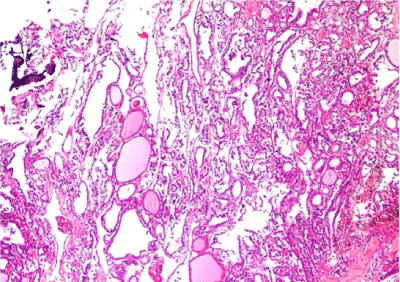 Metastatic papillary